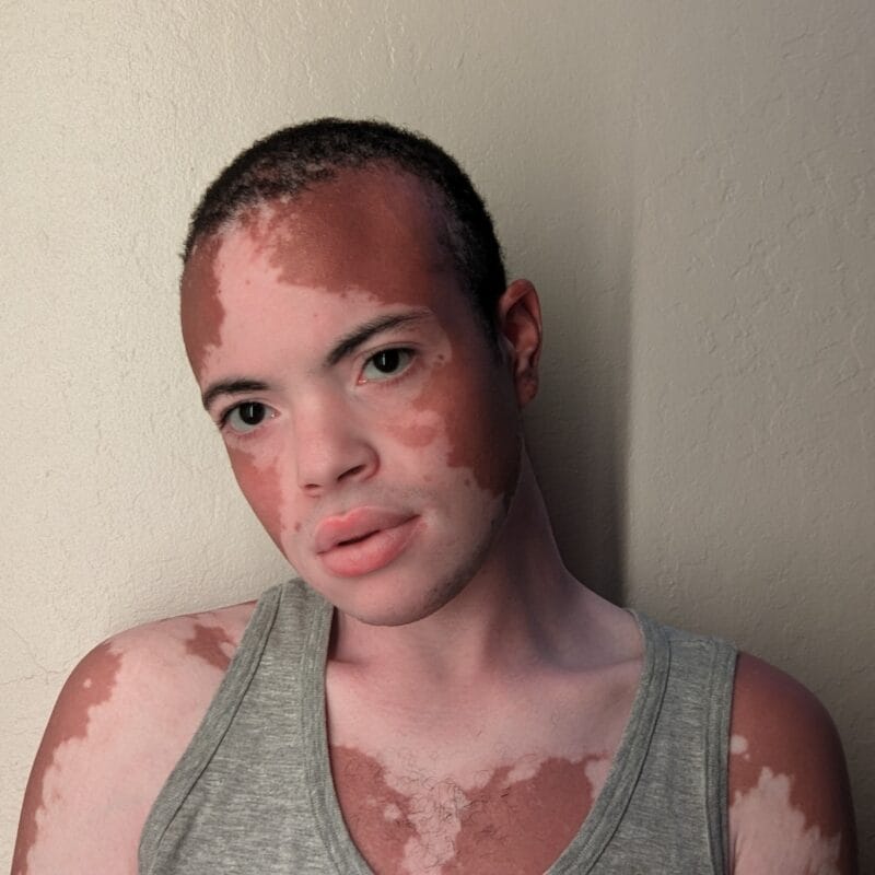 Gabriel Trans OnlyFans - @vitiligoftmboi